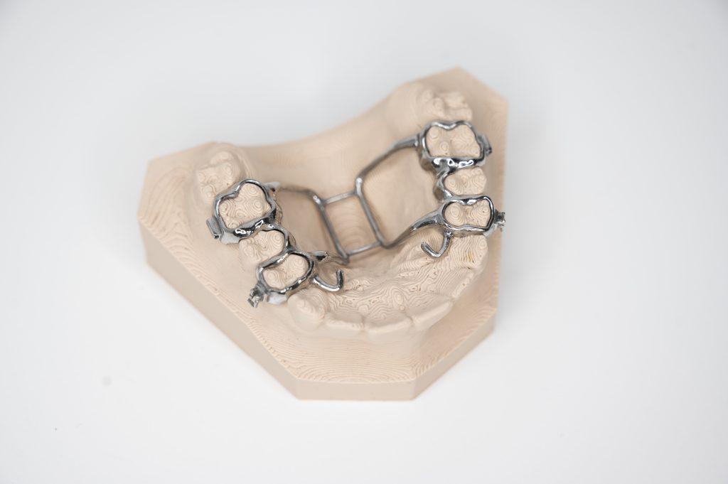 Individuell gefertigte Metallapparatur auf Oberkiefermodell für die Verankerung mit Mini-Pins.