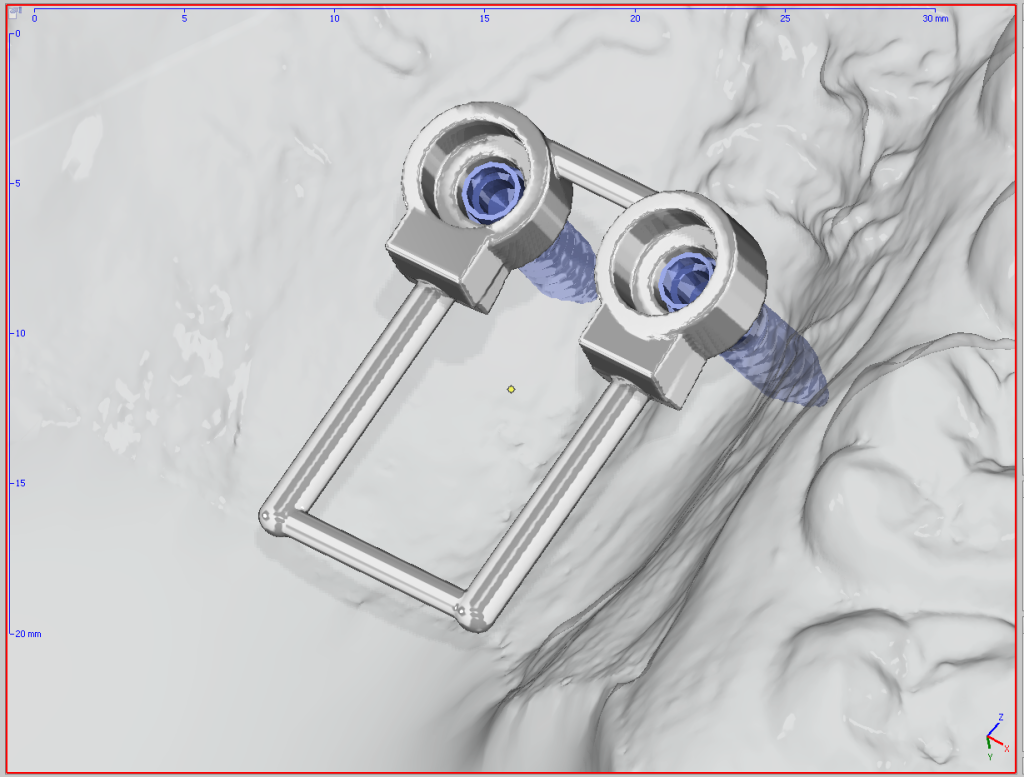 3D-Planung: zwei Mini-Pins im Gaumen mit Bügelapparatur als fester Ankerpunkt.